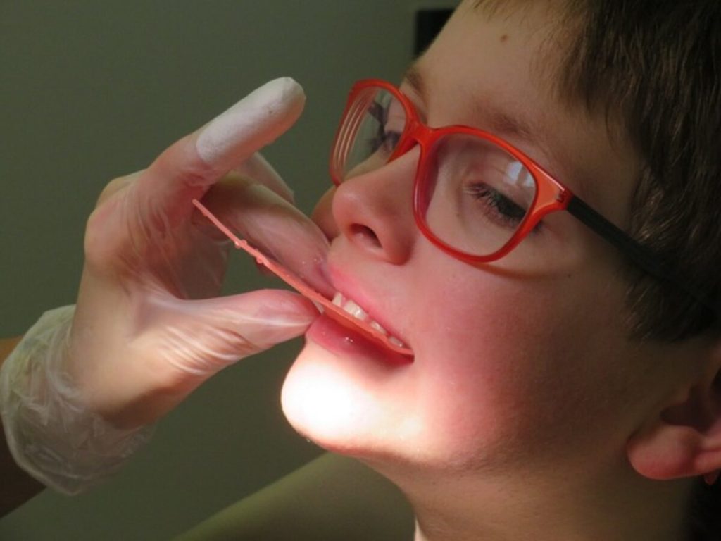 Teeth Whitening